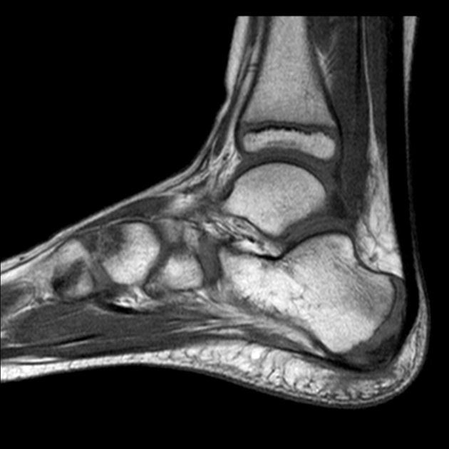 MRI Right Heel